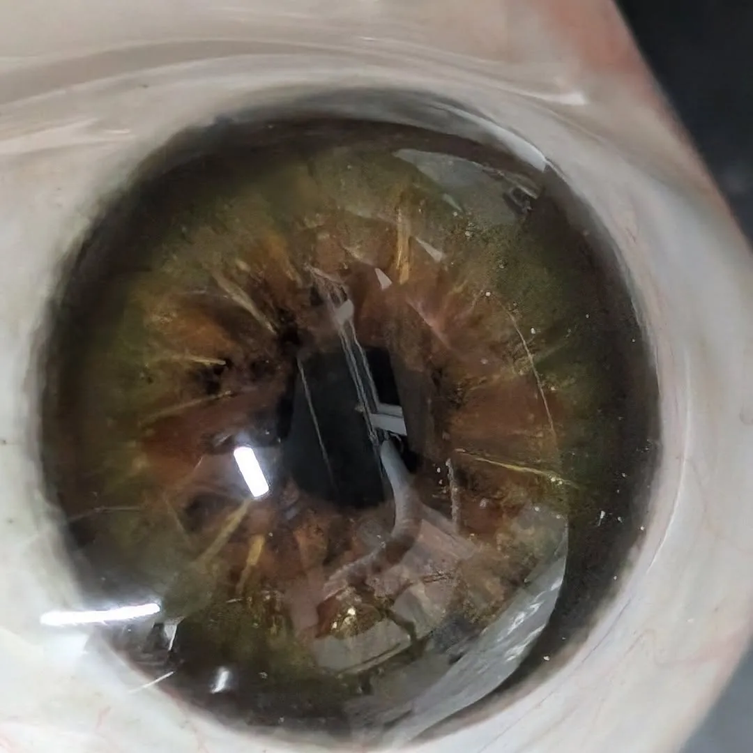 Uniquely shaped prosthetic eye with extra volume along the top edge, resembling a playful elf-hat silhouette, designed to restore natural fullness around the socket