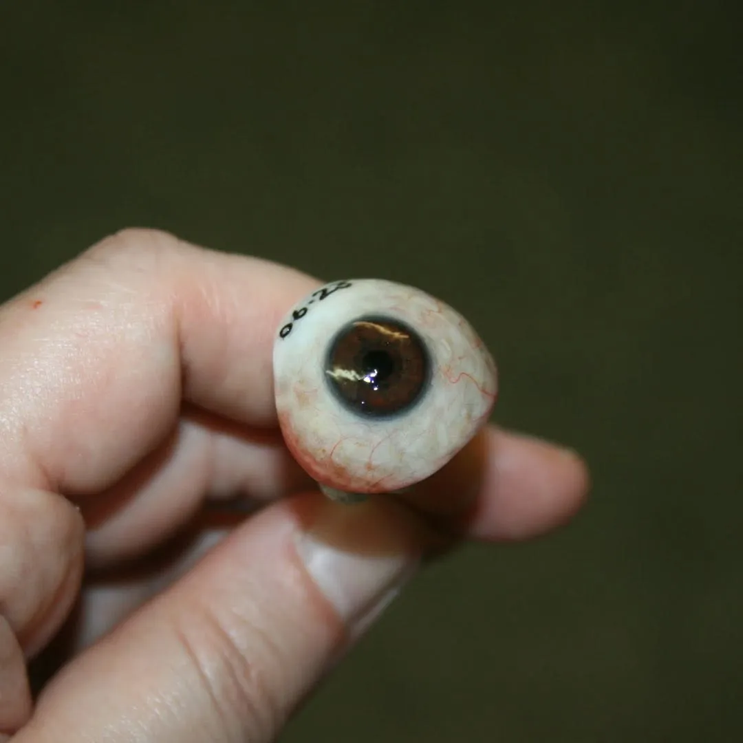 Pair of bespoke prosthetic eyes with deep brown irises and natural scleral vessel detail, crafted to match a patient's warm eye colour